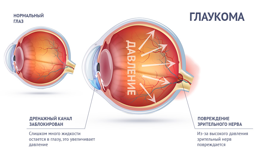 Диагностика и лечение глаукомы